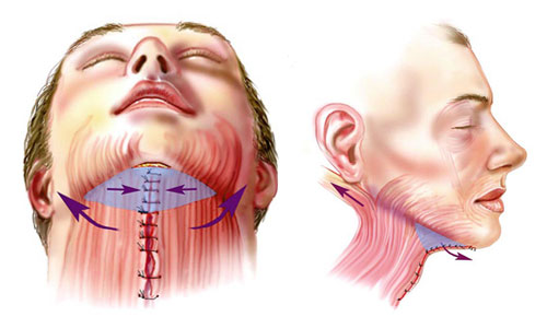 пластическая операция по подтяжке шеи – платизмопластика